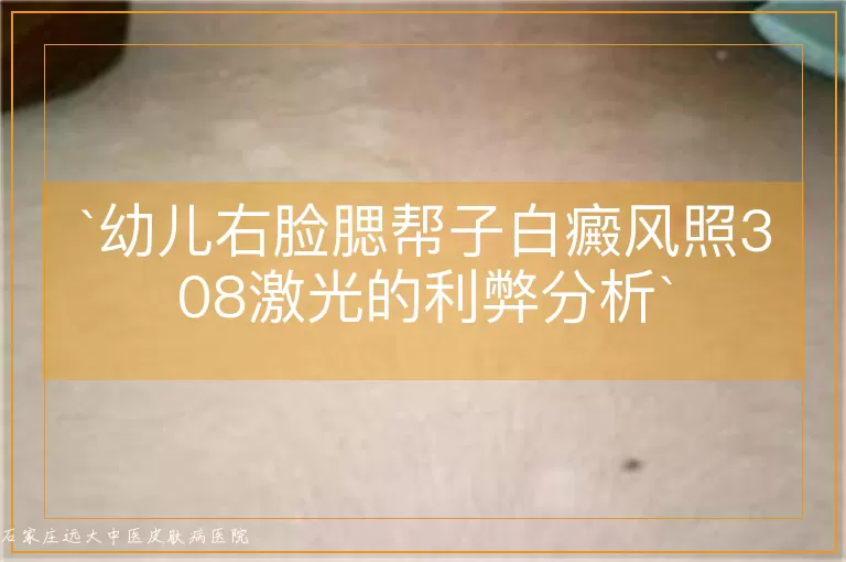 幼儿右脸腮帮子白癜风照308激光的利弊分析