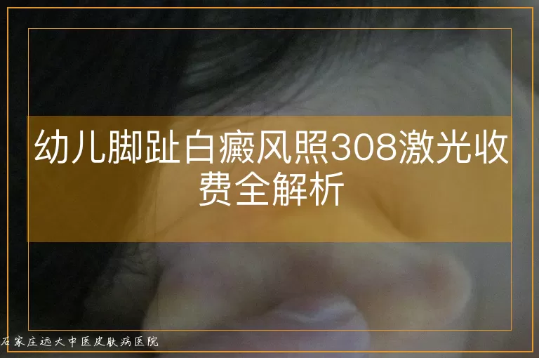 幼儿脚趾白癜风照308激光收费全解析