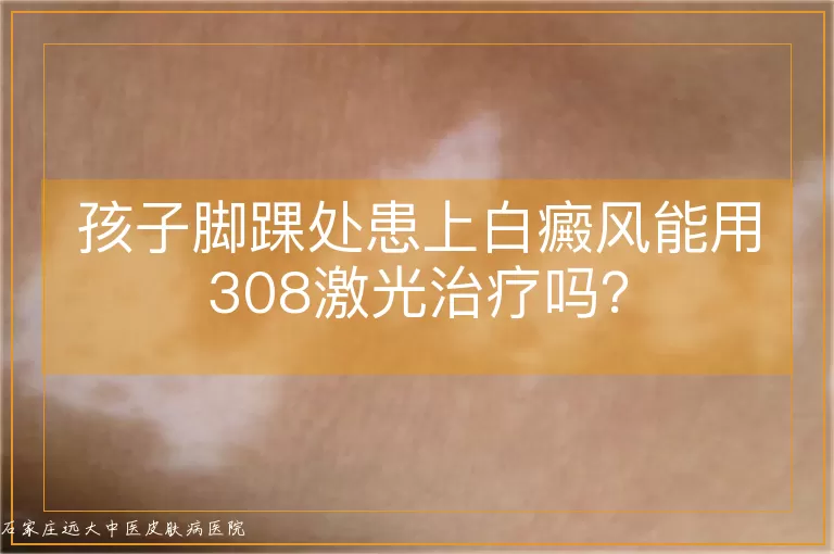 孩子脚踝处患上白癜风能用308激光治疗吗？