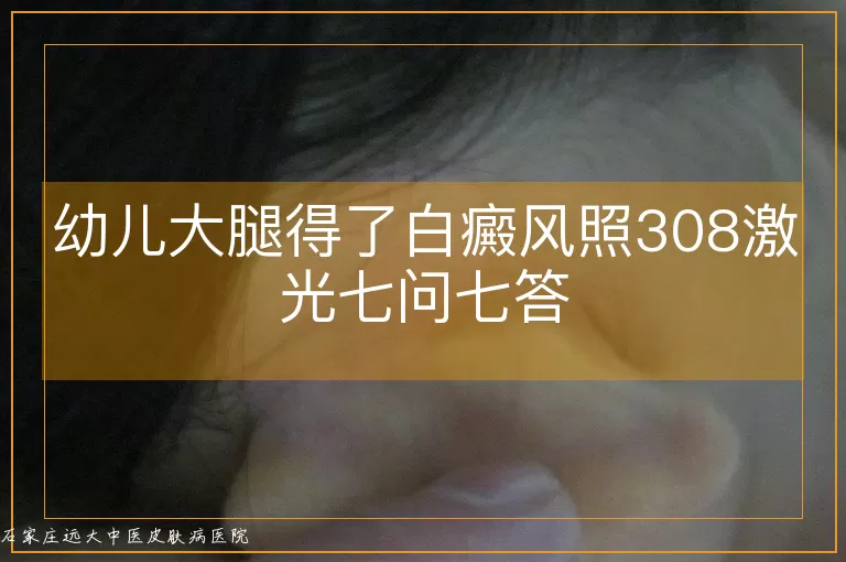 幼儿大腿得了白癜风照308激光七问七答