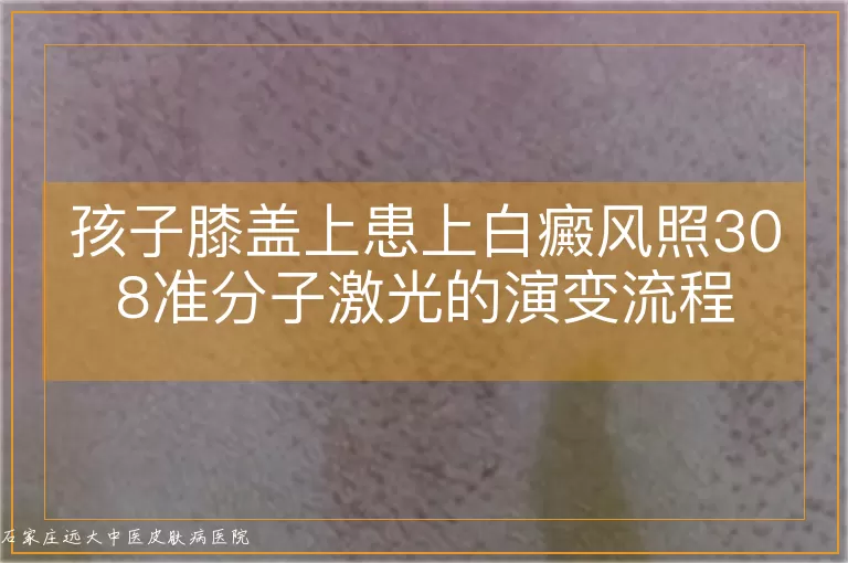 孩子膝盖上患上白癜风照308准分子激光的演变流程