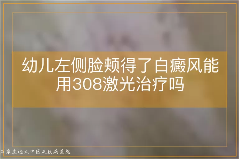 幼儿左侧脸颊得了白癜风能用308激光治疗吗