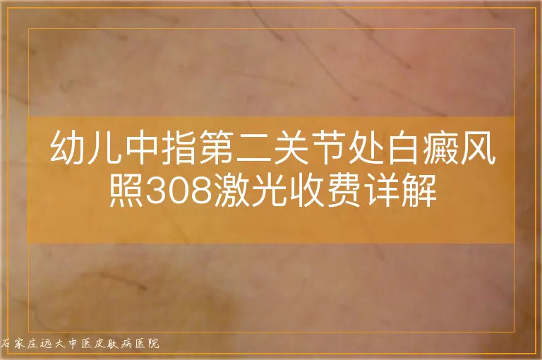幼儿中指第二关节处白癜风照308激光收费详解