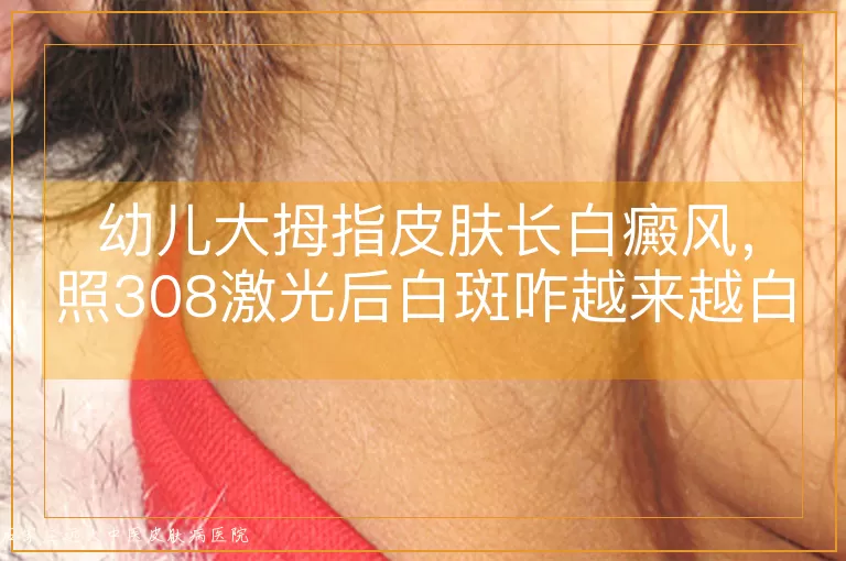 幼儿大拇指皮肤长白癜风，照308激光后白斑咋越来越白了？