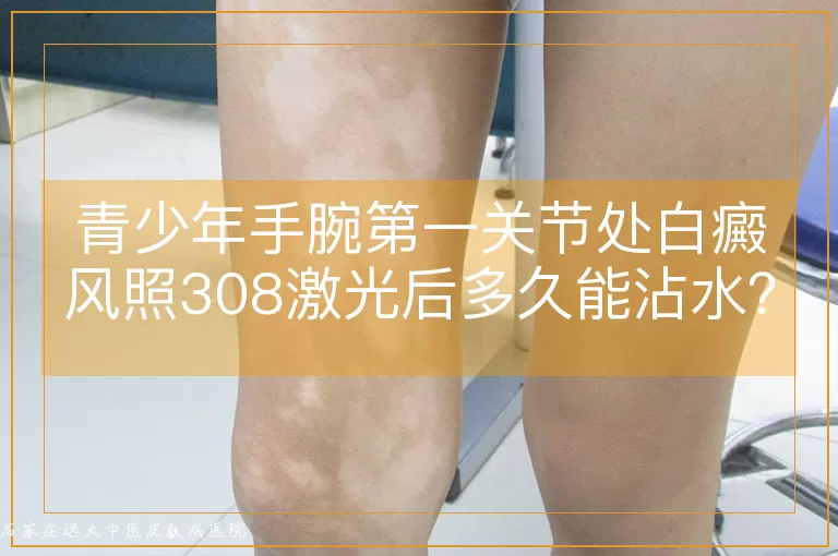 青少年手腕第一关节处白癜风照308激光后多久能沾水?
