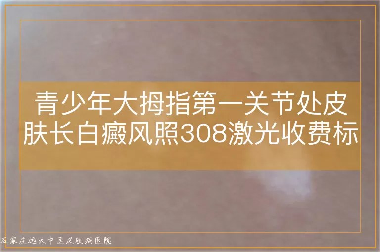 青少年大拇指第一关节处皮肤长白癜风照308激光收费标准详解