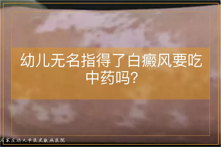 幼儿无名指得了白癜风要吃中药吗？