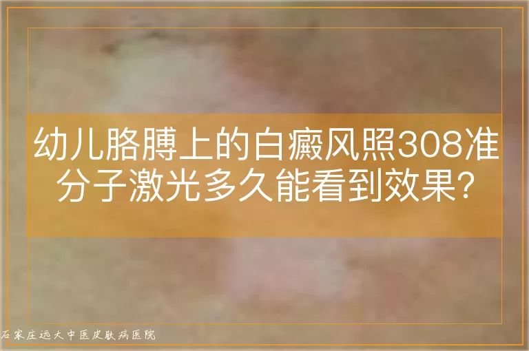 幼儿胳膊上的白癜风照308准分子激光多久能看到效果？