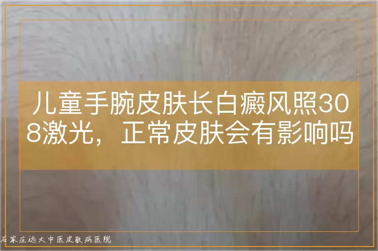 儿童手腕皮肤长白癜风照308激光，正常皮肤会有影响吗？