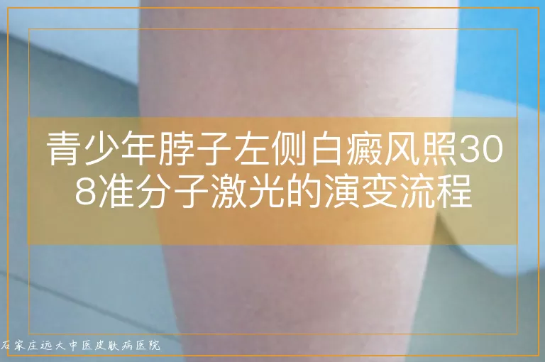青少年脖子左侧白癜风照308准分子激光的演变流程