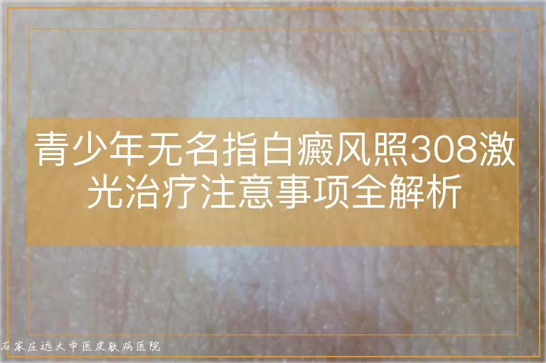 青少年无名指白癜风照308激光治疗注意事项全解析