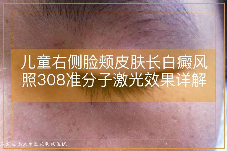 儿童右侧脸颊皮肤长白癜风照308准分子激光效果详解