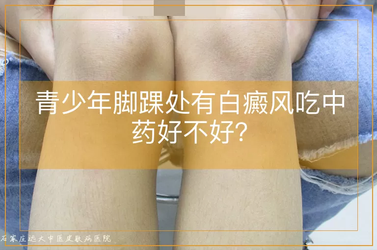 青少年脚踝处有白癜风吃中药好不好？