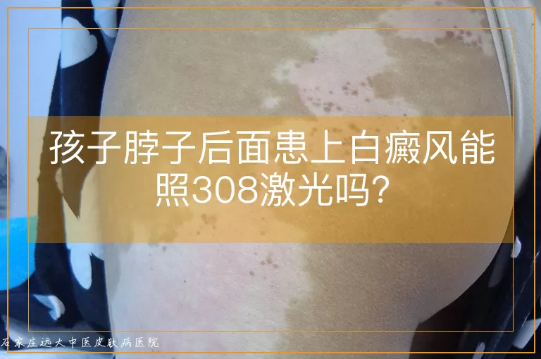 孩子脖子后面患上白癜风能照308激光吗？