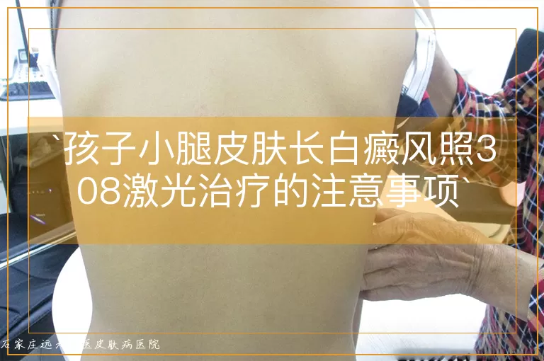 孩子小腿皮肤长白癜风照308激光治疗的注意事项