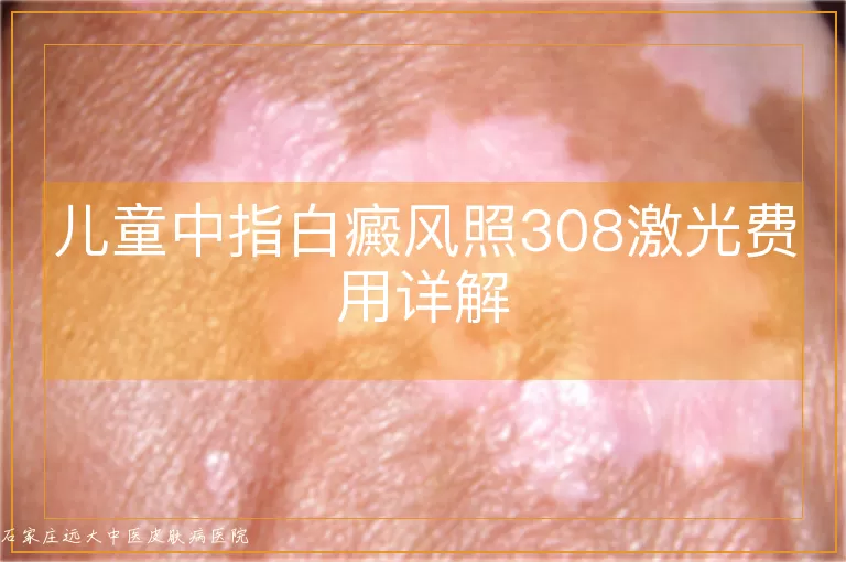 儿童中指白癜风照308激光费用详解