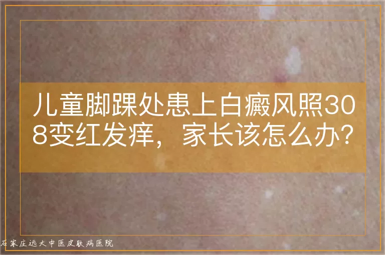儿童脚踝处患上白癜风照308变红发痒，家长该怎么办？