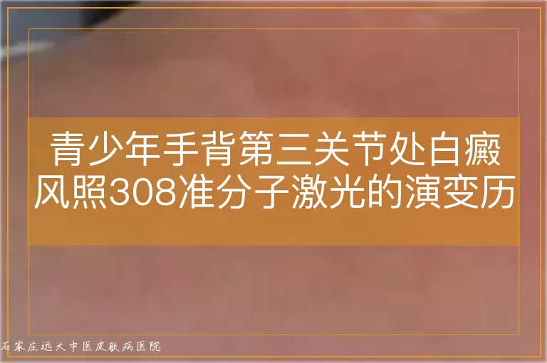 青少年手背第三关节处白癜风照308准分子激光的演变历程