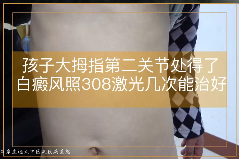 孩子大拇指第二关节处得了白癜风照308激光几次能治好