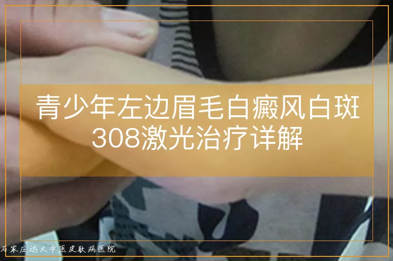 青少年左边眉毛白癜风白斑308激光治疗详解