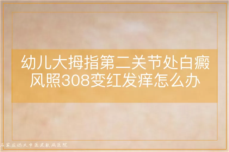 幼儿大拇指第二关节处白癜风照308变红发痒怎么办