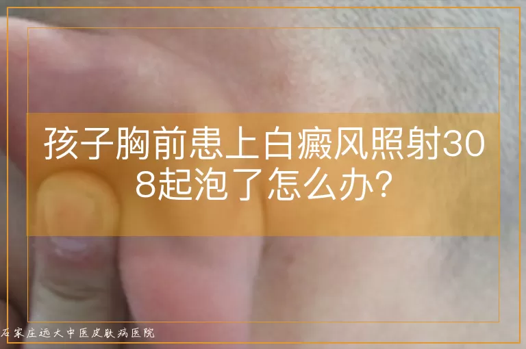 孩子胸前患上白癜风照射308起泡了怎么办?