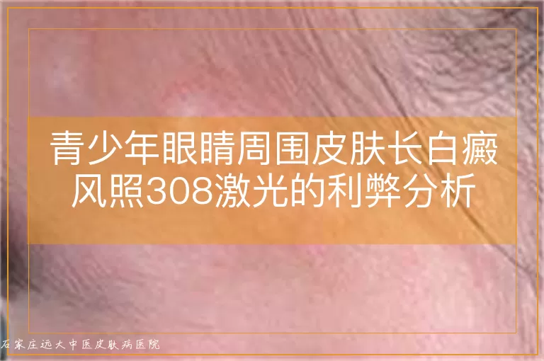 青少年眼睛周围皮肤长白癜风照308激光的利弊分析