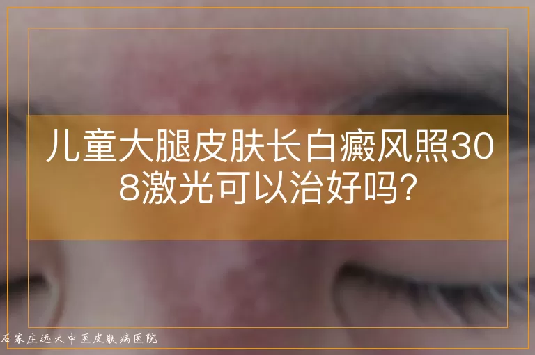 儿童大腿皮肤长白癜风照308激光可以治好吗？