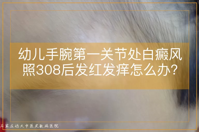 幼儿手腕第一关节处白癜风照308后发红发痒怎么办?