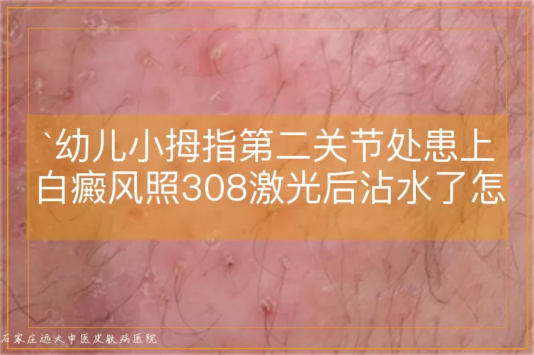 幼儿小拇指第二关节处患上白癜风照308激光后沾水了怎么办？