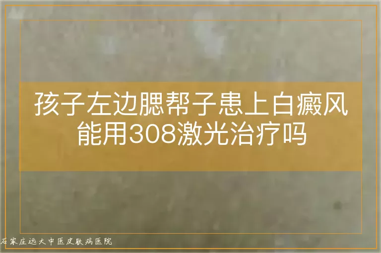 孩子左边腮帮子患上白癜风能用308激光治疗吗