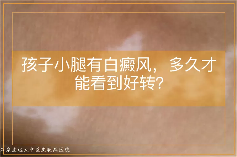 孩子小腿有白癜风，多久才能看到好转？