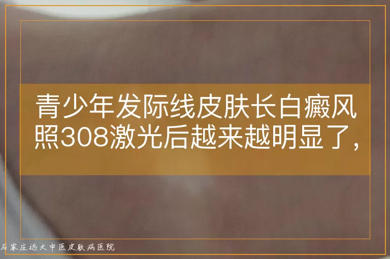 青少年发际线皮肤长白癜风照308激光后越来越明显了，怎么回事？