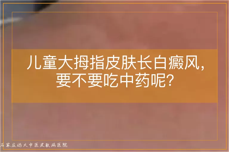 儿童大拇指皮肤长白癜风，要不要吃中药呢？