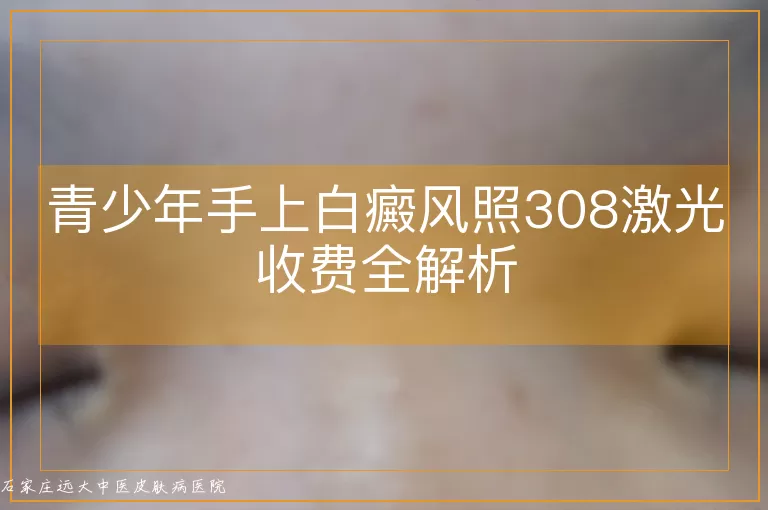 青少年手上白癜风照308激光收费全解析