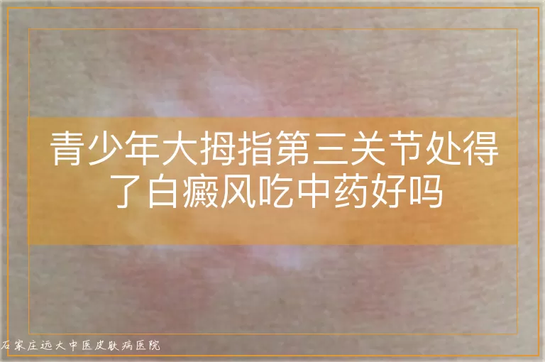 青少年大拇指第三关节处得了白癜风吃中药好吗
