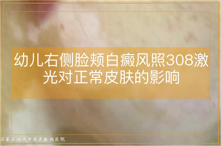 幼儿右侧脸颊白癜风照308激光对正常皮肤的影响
