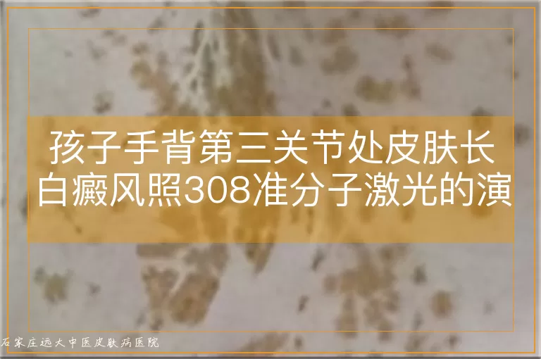 孩子手背第三关节处皮肤长白癜风照308准分子激光的演变流程