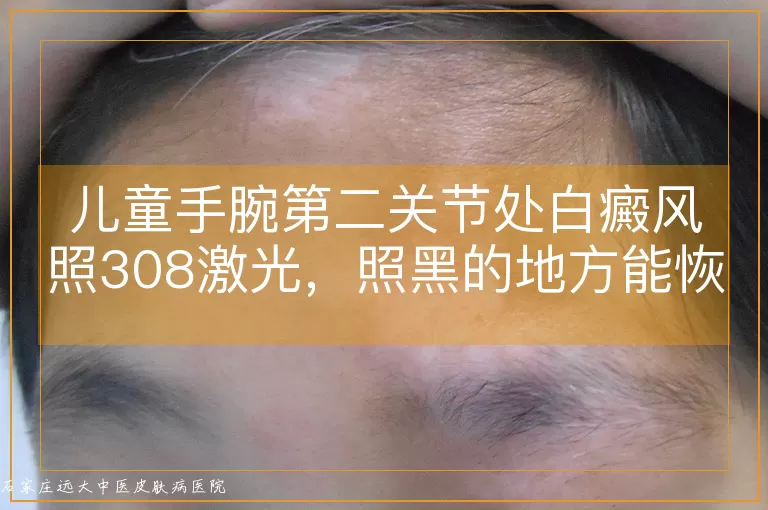 儿童手腕第二关节处白癜风照308激光，照黑的地方能恢复吗？