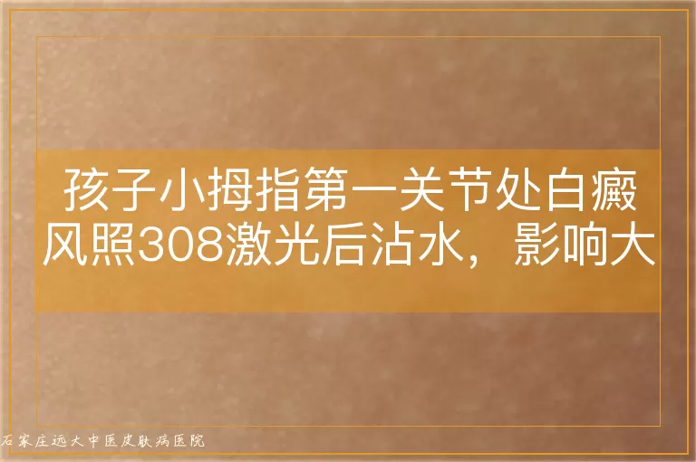 孩子小拇指第一关节处白癜风照308激光后沾水,影响大吗?