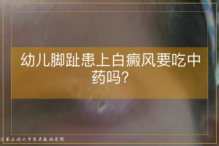 幼儿脚趾患上白癜风要吃中药吗？