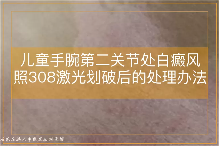 儿童手腕第二关节处白癜风照308激光划破后的处理办法