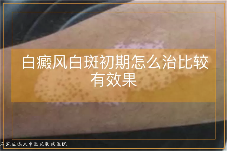 白癜风白斑初期怎么治比较有效果