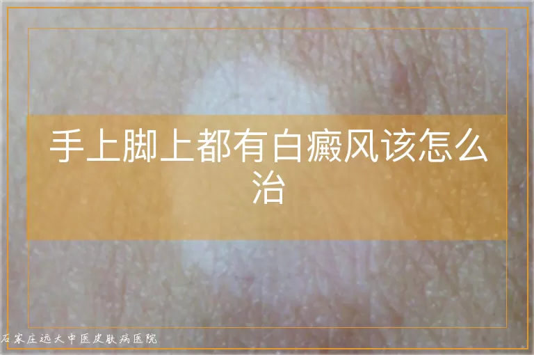 手上脚上都有白癜风该怎么治