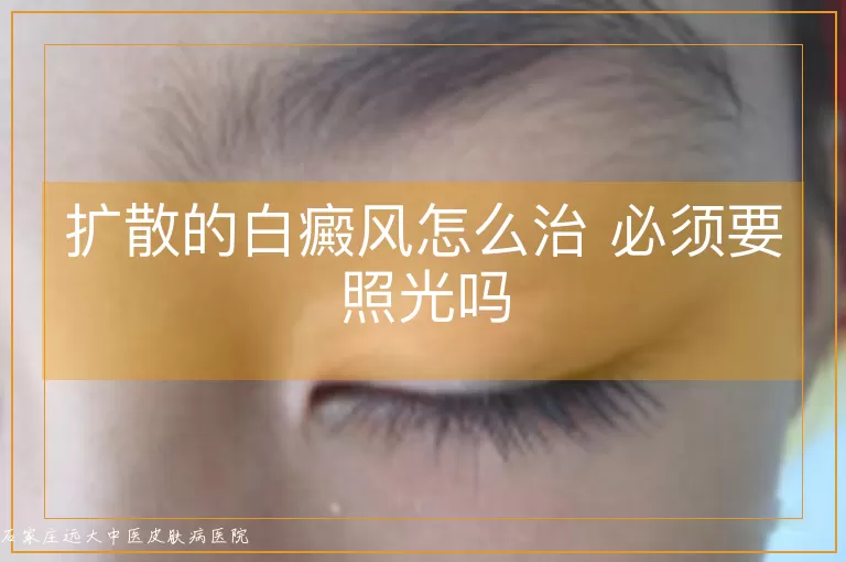 扩散的白癜风怎么治 必须要照光吗