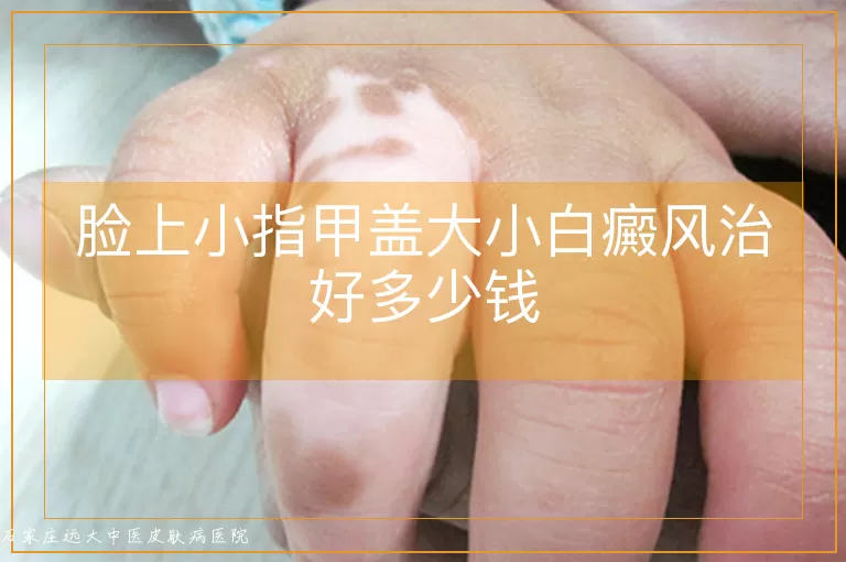 脸上小指甲盖大小白癜风治好多少钱