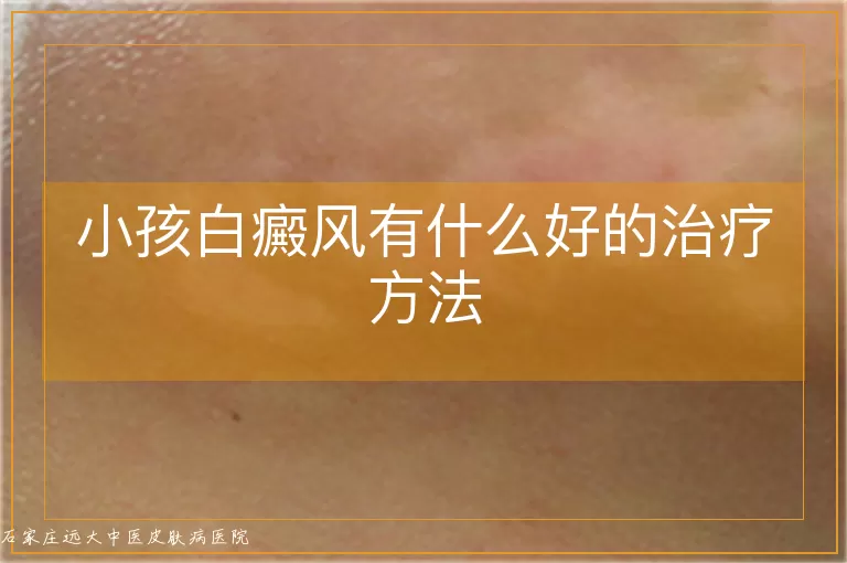 小孩白癜风有什么好的治疗方法