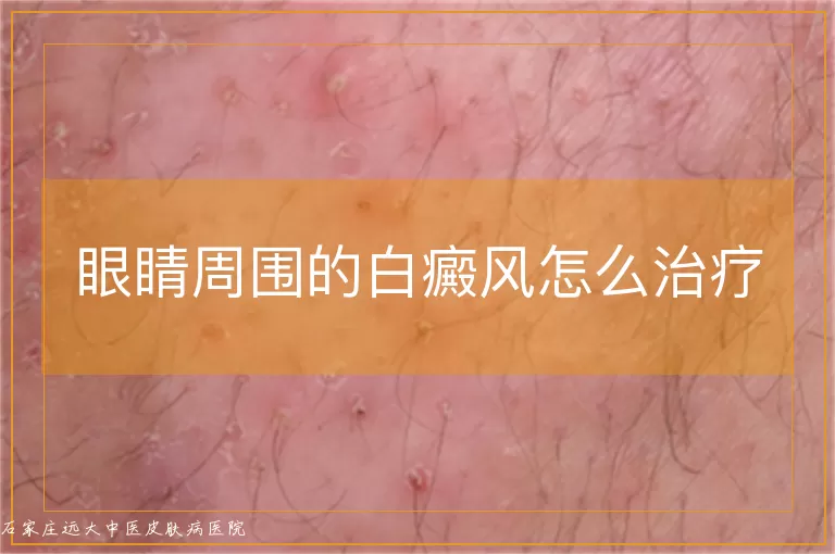 眼睛周围的白癜风怎么治疗