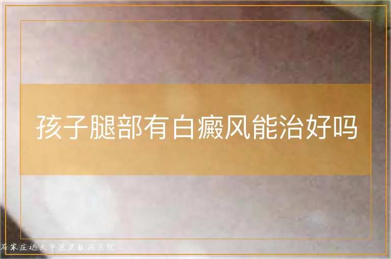 孩子腿部有白癜风能治好吗