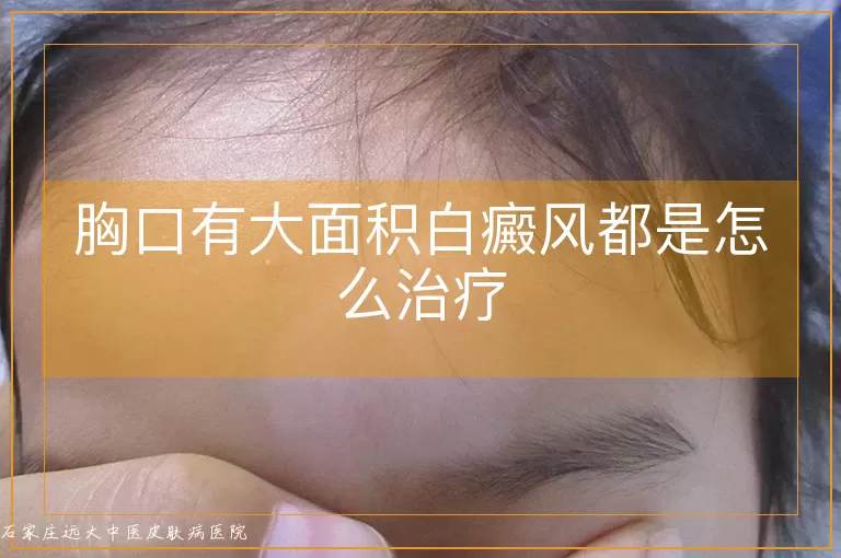 胸口有大面积白癜风都是怎么治疗